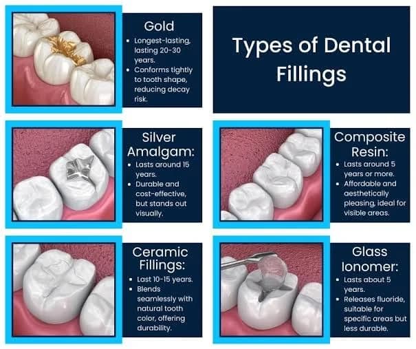 Chart of dental filling materials — gold, silver amalgam, composite resin, ceramic and glass ionomer