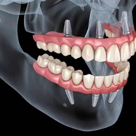 A 3D illustration of dental implants anchored in the jawbone, supporting a full arch of teeth